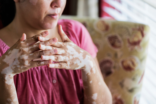 Pesquisa da UFLA investiga potenciais benefícios da serralha no tratamento contra o vitiligo